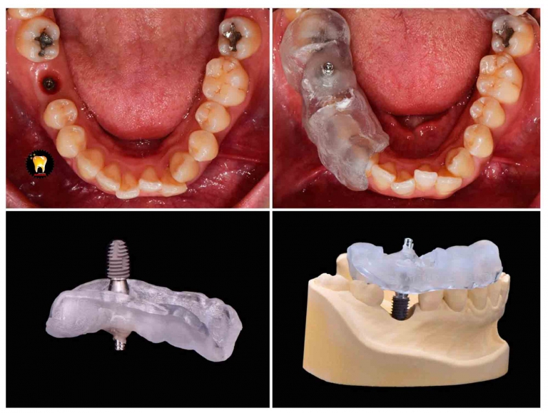 بررسي روش هاي جراحي ايمپلنت دندان و کاشت آن