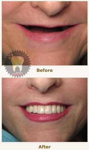 قبل و بعد از کاشت ایمپلنت دندان 