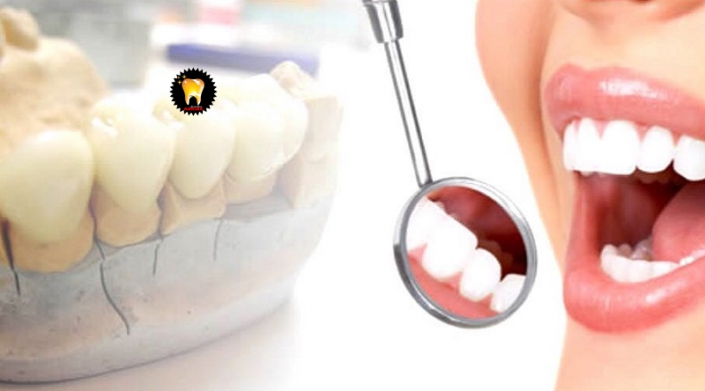 ایمپلنت دندان و طول درمان آن