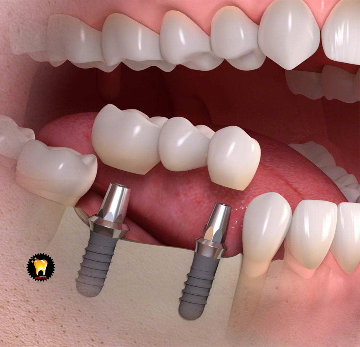 شبیه سازی ایمپلنت در دندان پزشکی