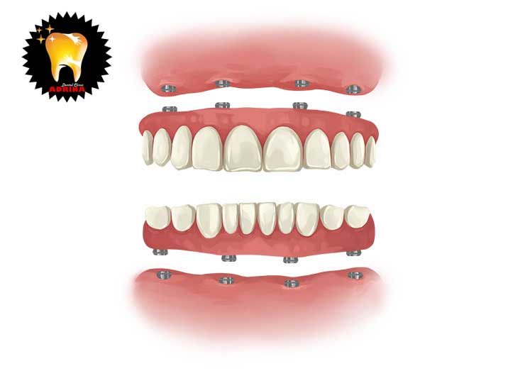 ایمپلنت دندان 