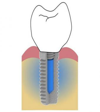 ایمپلنت دندانی 