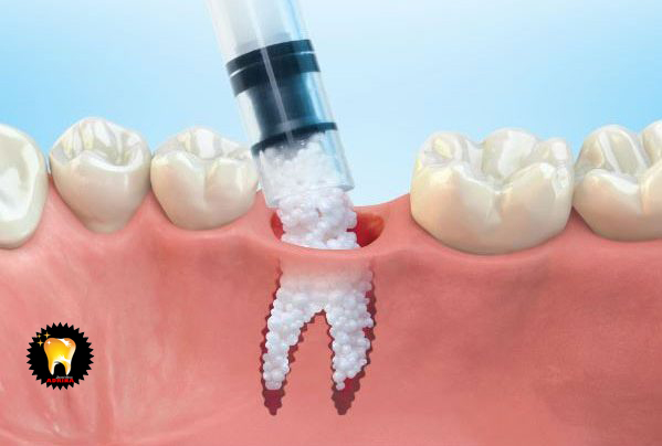 طول درمان و مدت زمان ایمپلنت دندان
