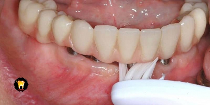ايمپلنت دندان و طول درمان آن