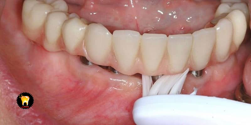 ایمپلنت دندان و مدت زمان درمان