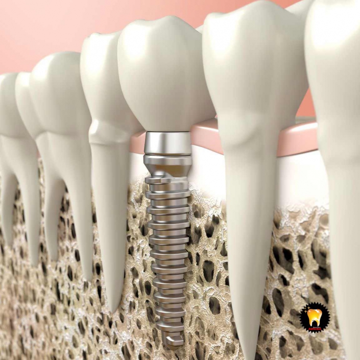 عوامل نارسايي ايمپلنت دندان