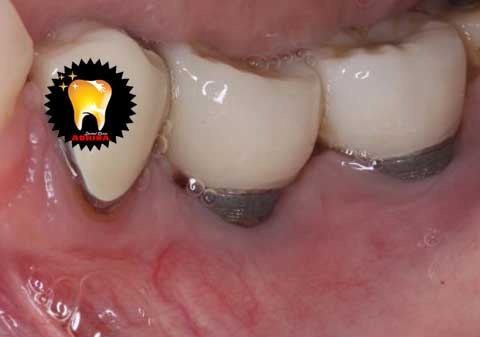 ارتباط بیماری های لثه با ایمپلنت دندان 