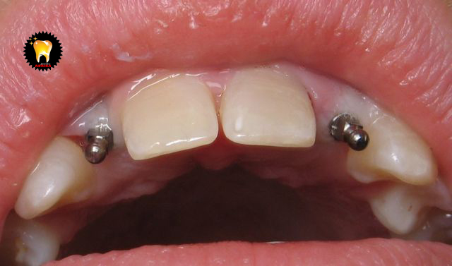 کاشت ایمپلنت دندان کودکان