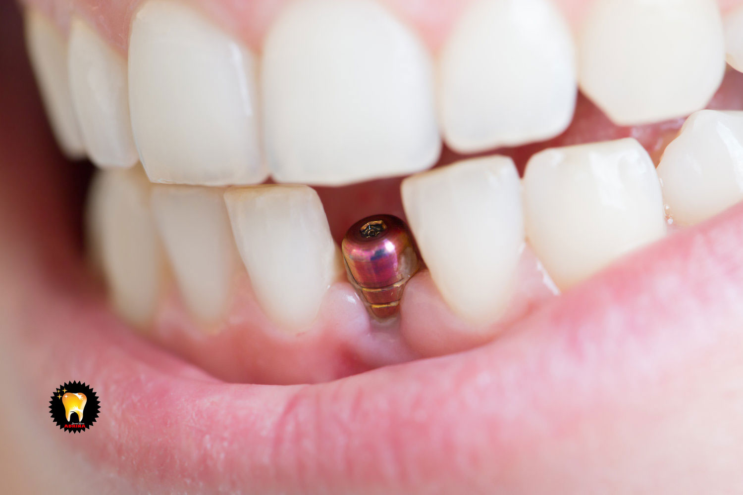 بررسی عوامل عدم موفقیت ایمپلنت دندان