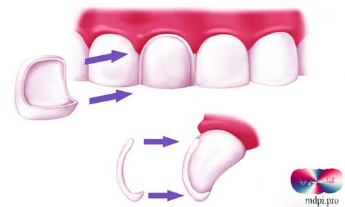 انواع لمینت دندان 