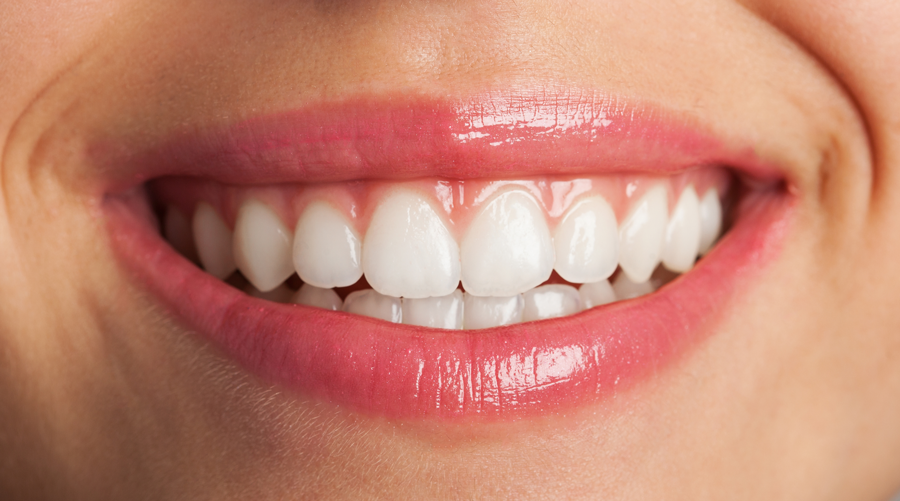 بهترین رنگ لمینت دندان کدام است؟