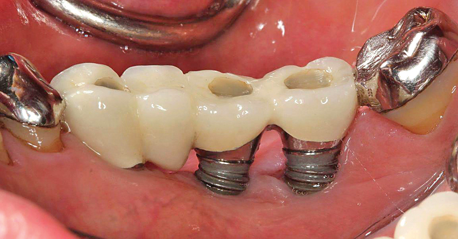 عوامل موفقیت ایمپلنت دندان
