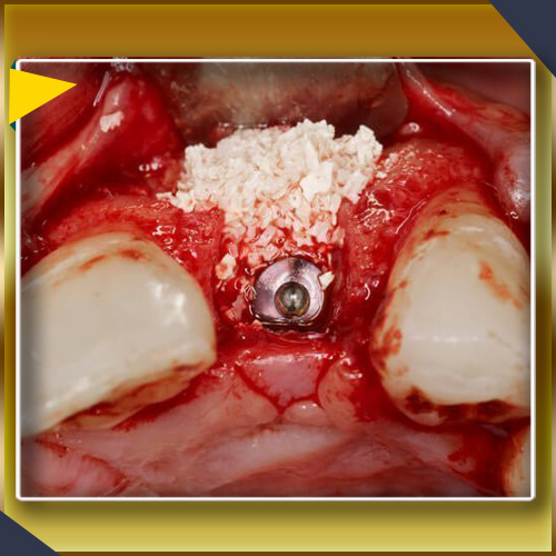ایمپلنت های دندانی و اتصال آن با استخوان فک
