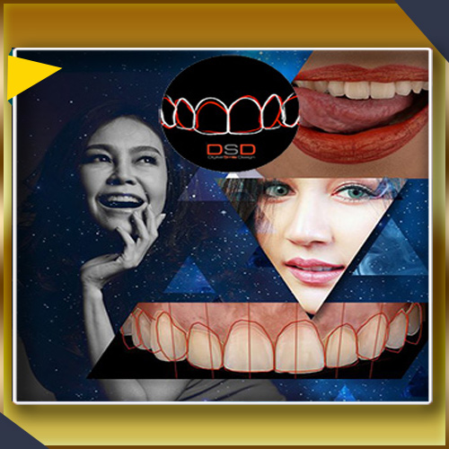 لبخند دیجیتال ایمپلنت دندان