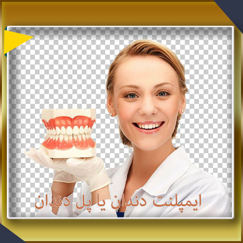 تفاوت بین ایمپلنت های دندانی و پلهای دندان
