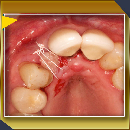 ایمپلنت دندان افزایش استخوان فک