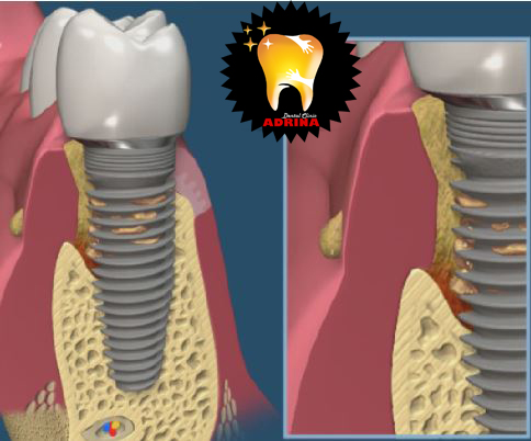 عوارض ایمپلنت دندان 