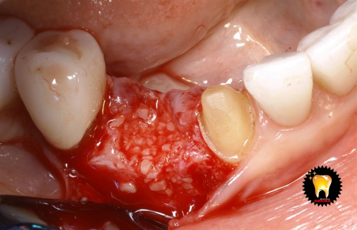 ایمپلنت دندان به همراه پیوند استخوان