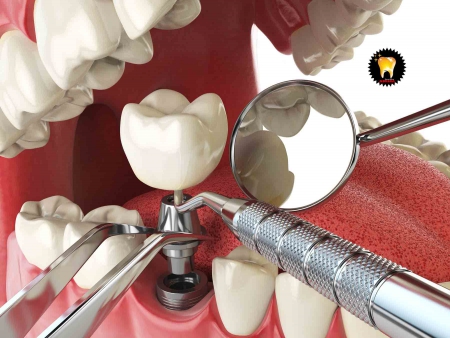 سریع ترین روش های کاشت ایمپلنت دندان