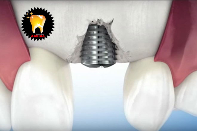 ایمپلنت دندان و درمان آن
