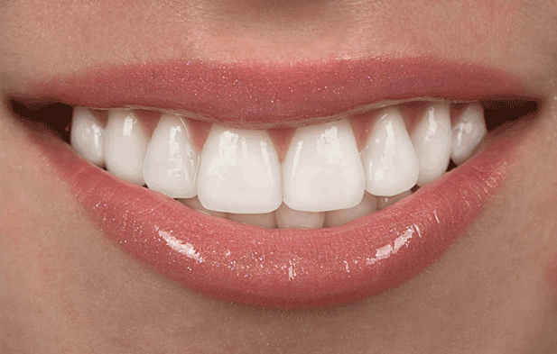 دقیقاً چند دندان باید لمینت شود تا ما طرح لبخند زیبایی داشته باشیم؟