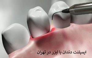 ایمپلنت دندان با لیزر در تهران
