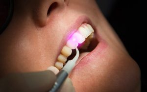 جراحی دندان عقل با لیزر در تهران